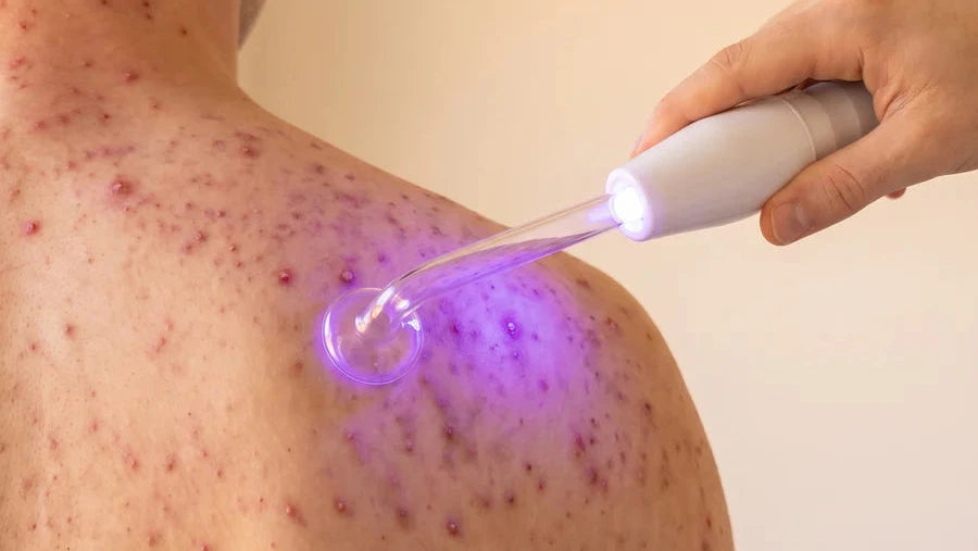 VIORA High Frequency Wand